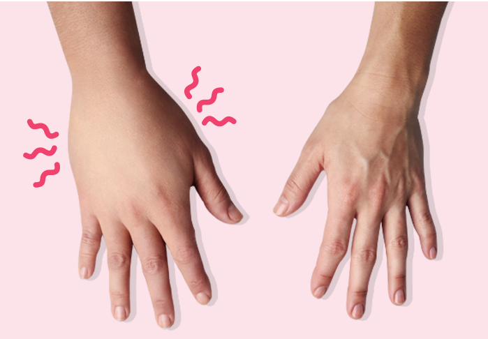 Conozca más del Angioedema Hereditario Conozca más del Angioedema Hereditario